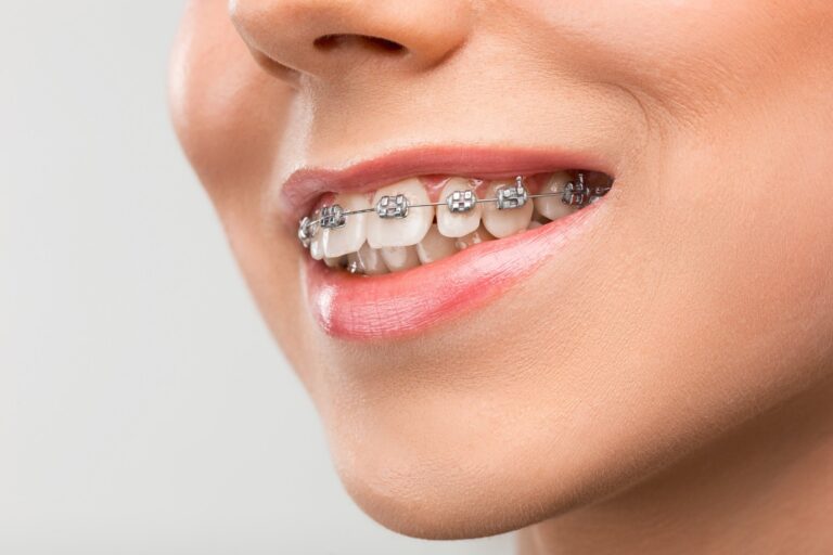 ពាក់ប្រេសពត់ធ្មេញ