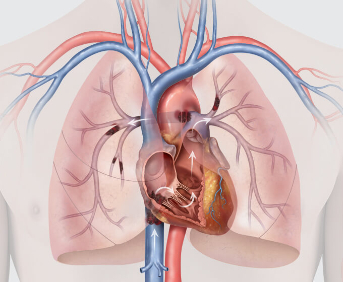 តើបញ្ហាស្ទះដុំកំណកឈាមក្នុងសួត បណ្តាលមកពីអ្វី